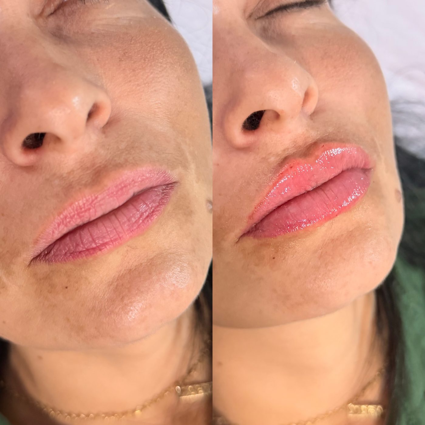 Antes e depois — Preenchimento labial