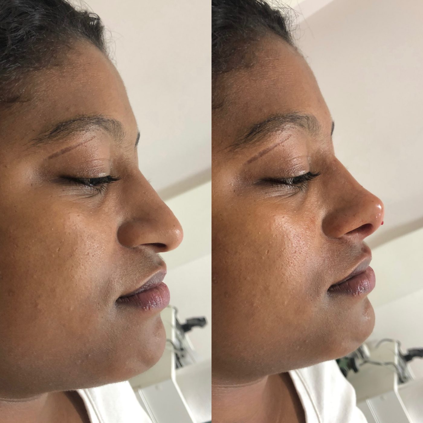 Antes e depois — Harmonização integral